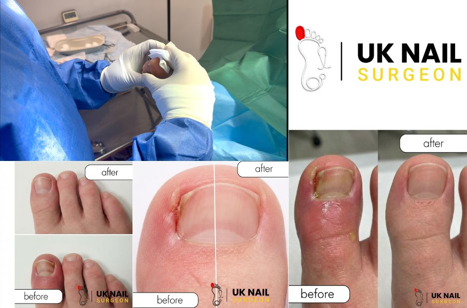 Relief and care: managing painful toenail ingrowth safely Relief and care: managing painful toenail ingrowth safely