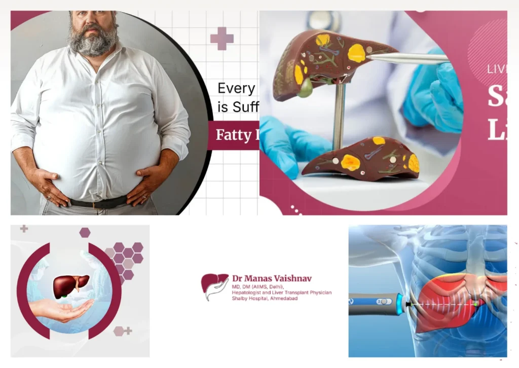 Comprehensive Liver Transplant in Ahmedabad and Gujarat with Expert Care and Advanced Treatment